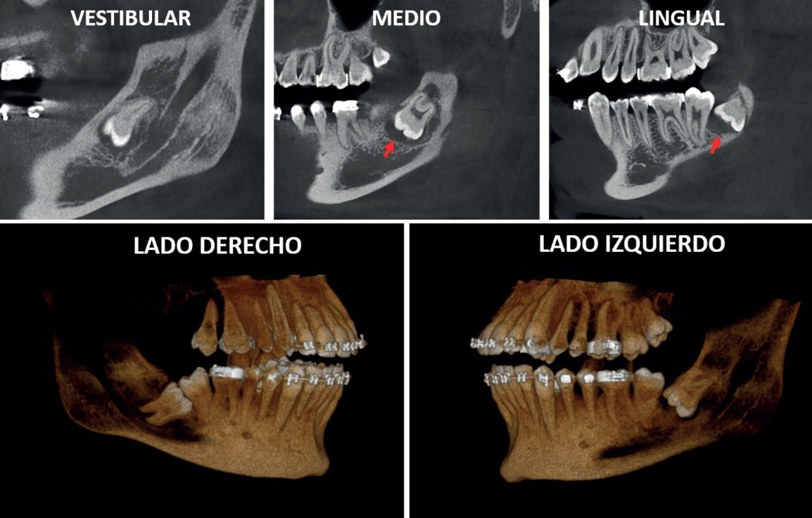Tomografía 3D (CBCT)